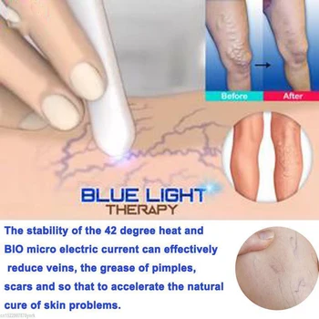 Visoka Kakovost Prenosni Modra Svetloba Odstrani Akne Pero Gubam Odstranitev Orodje Za Nego Kože